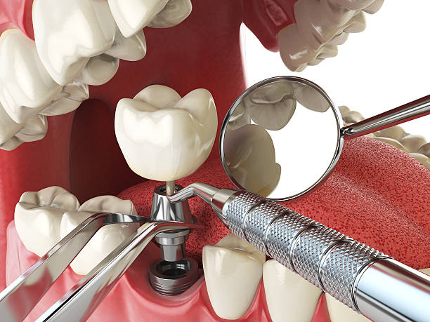 Best Emergency Root Canal Treatment in Cleveland Heights, OH